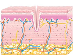 Diagram of Untreated Skin